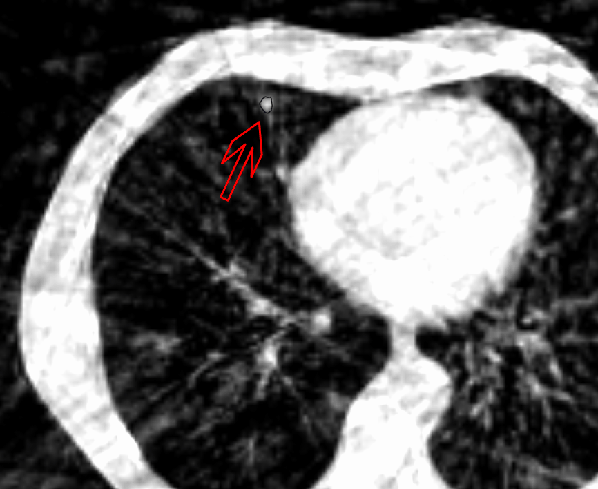 Résultat d'imagerie pour un examen de radiothérapie stéréotaxique en plan transverse montrant un cancer des poumons