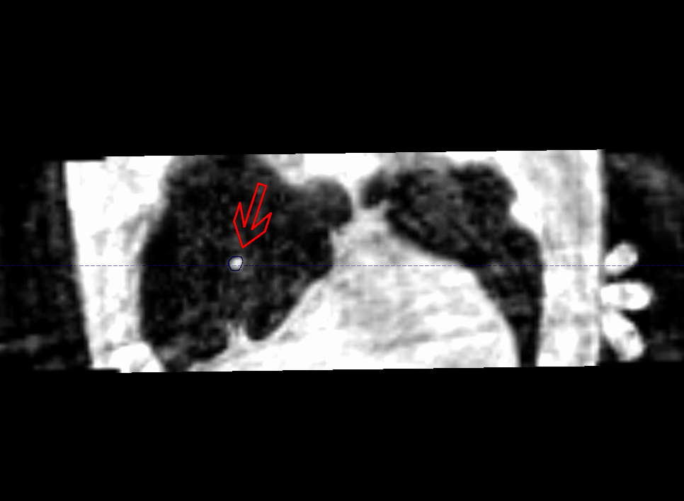 Résultat d'imagerie de radiothérapie stéréotaxique en plan frontal montrant un cancer des poumons