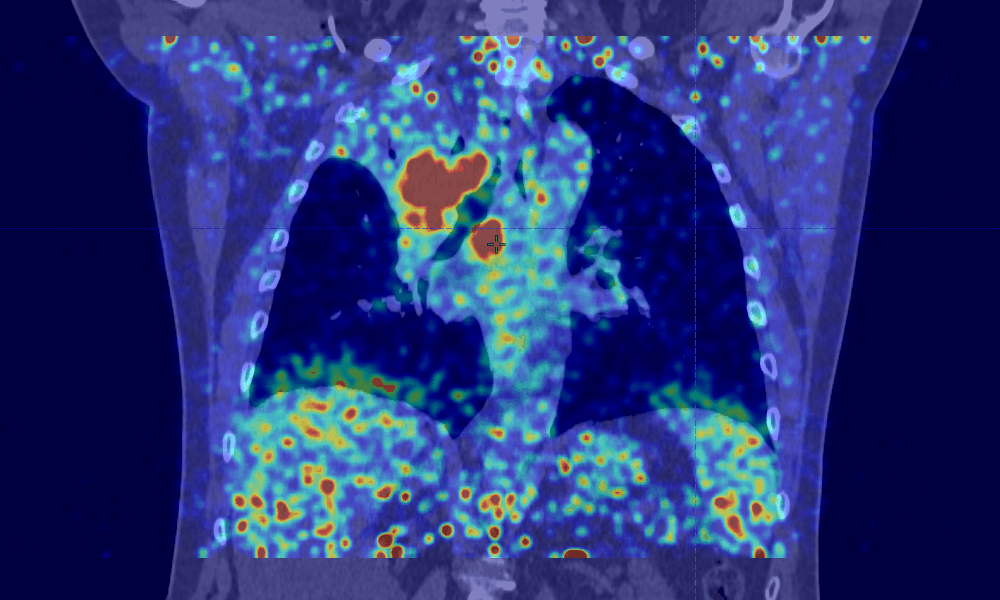 Résultat d'imagerie dynamique d'un TEP4D d'un cancer des poumons