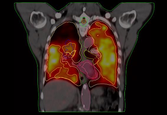 Résultat d'imagerie d'une scintigraphie de perfusion mettant en avant un cancer des poumons
